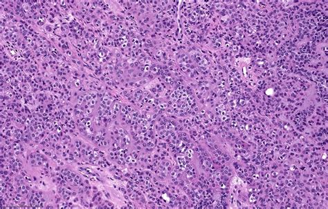 Pleomorphic Adenoma Parotid