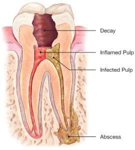 Root Canals: If my nerve is dead, why does... - Root Canals in Manchester