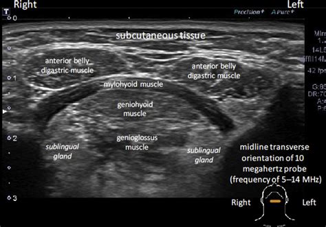 Parotid Gland Ultrasound Measurement