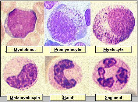 Myelocyte Vs Promyelocyte - - Yahoo | Medical laboratory, Medical ...