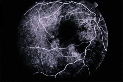 Choroidal Hemangioma / CNVM - Retina Image Bank