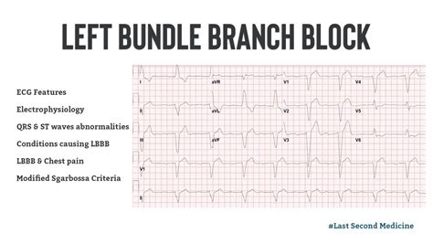 Left Bundle Branch Block - ECG Features, Electrophysiology, Causes ...