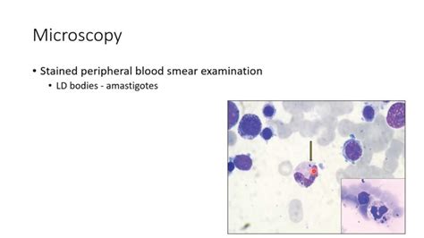 Kala-azar/ Leishmaniasis : Symptoms, Causes, Diagnosis, Management ...