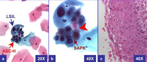 LSIL-H (with only HPV in biopsy): Cervical smear (a, b) showed ...