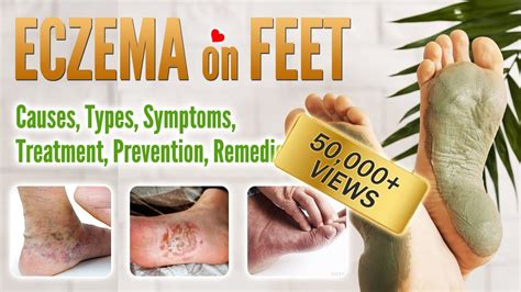 Eczema on foot Causes, Symptoms, Types, Treatment, Prevention and Home ...