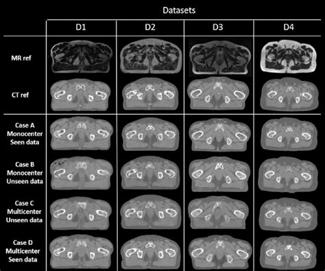 Preprocessed CT and MRI and image and sCT results according to the test ...