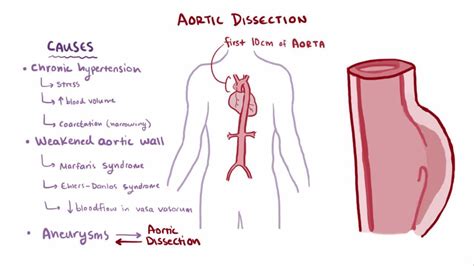 Aortic dissection - causes, symptoms - Healthy Food Near Me