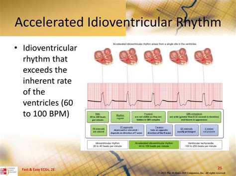 PPT - Ventricular Dysrhythmias PowerPoint Presentation - ID:5204970