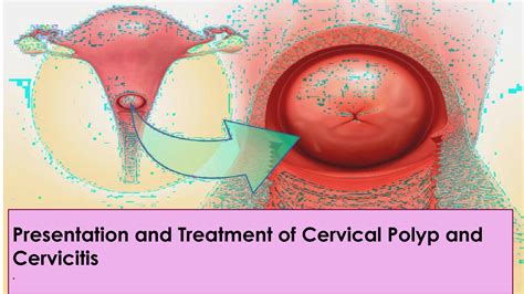 SOLUTION: Presentation and treatment of cervictis and cervical polyp ...