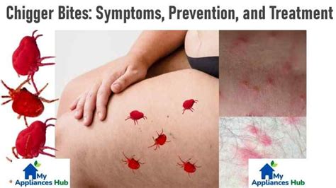 Chiggers 101: Symptoms, Prevention, Treatment, and Control of Chigger Bites