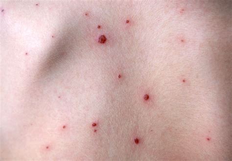 Bacterial or fungal infection of skin lesions - Pictures