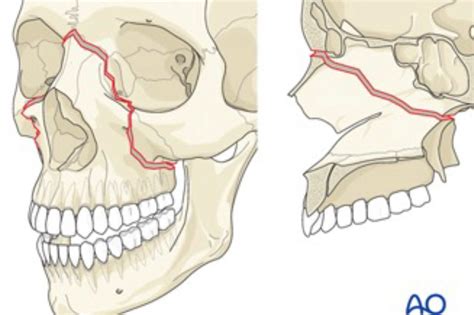 le-fort-fracture-4 - Dentistry.co.uk