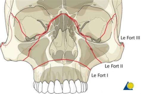 A Dental Student's Guide to...Le Fort fractures - Dentistry