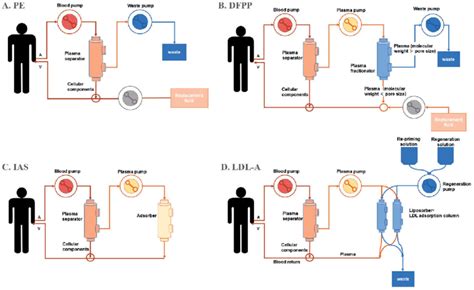 Schematic diagram of different therapeutic apheresis techniques. (A) In ...