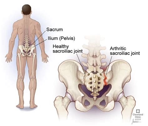 Ankylosing Spondylitis (AS) | Los Angeles | Pacific Arthritis Care Center