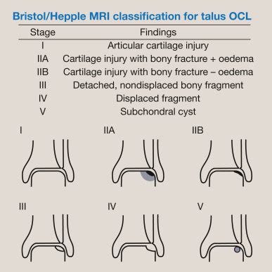 Management strategies in the treatment of osteochondral lesions of the ...