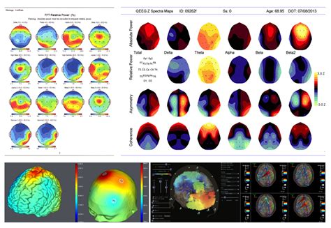 QEEG or quantitative EEG brain maps is the first step in helping you ...