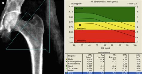 Dxa Scan Results