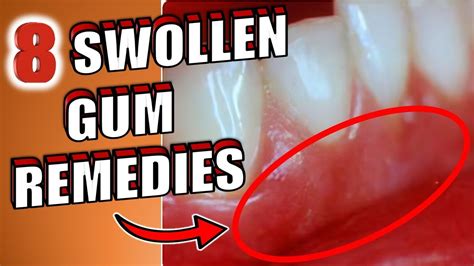 8 Home Remedies To Get Rid of Swollen Gums - YouTube