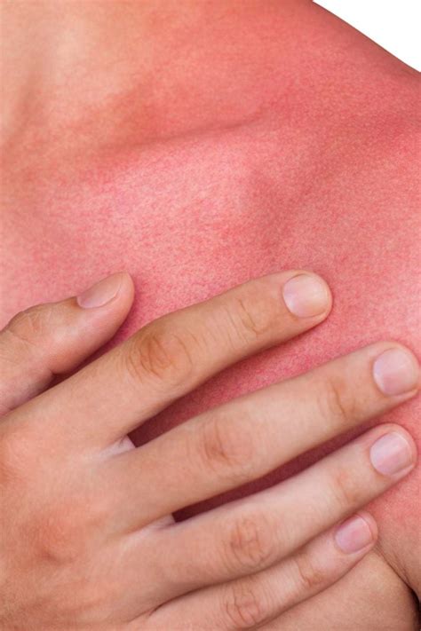 Skin redness: Causes and when to see a doctor