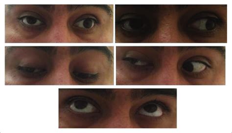 Neuro exam on day 1 of steroid treatment reveals right palpebral ptosis ...