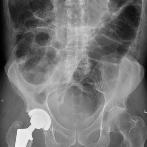 Colonic pseudo-obstruction - Radiology at St. Vincent's University Hospital