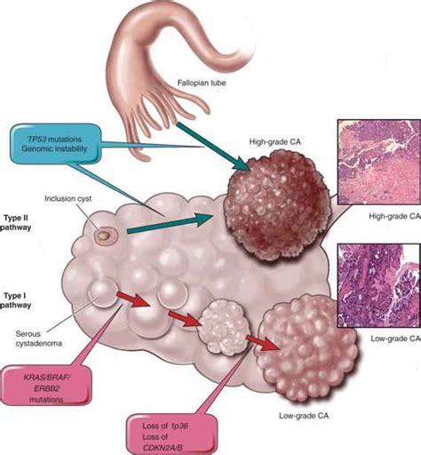 Epithelial Ovarian Cancers: Low Malignant Potential and Non-Serous ...