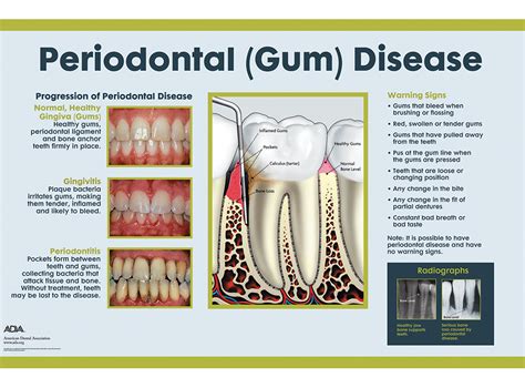 Dental Wall Art - Periodontal Disease Chart 22x28 DAW014MU DAW014