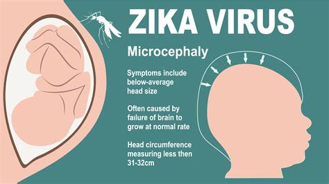 Zika and Pregnancy: Symptoms, Effects and Prevention