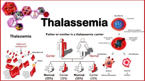 Thalassemia Types Causes Symptoms Diagnosis And Treatment | The Best ...