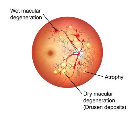 Benefits of Early Macular Degeneration Diagnosis - La Jolla, CA