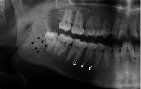 Mandibular Canal X Ray