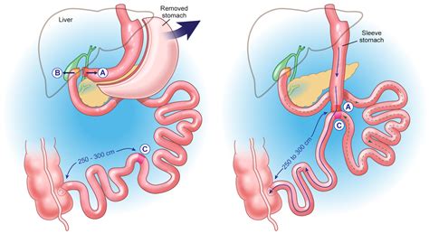 Duodenal Switch Surgery Dallas & Fort Worth Tx