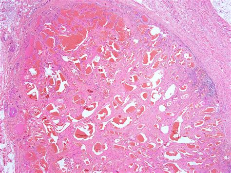 Pathology Outlines - Hemangioma & variants