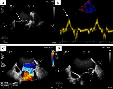 TEE demonstrating bileaflet mitral valve prolapse (a). High-velocity ...