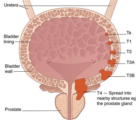 Bladder Cancer Stages, Artwork Photograph by Peter Gardiner