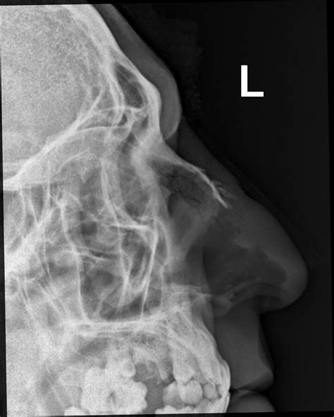 Nasal Bone Fracture Mri - Nasal bone fracture | Radiology Case ...