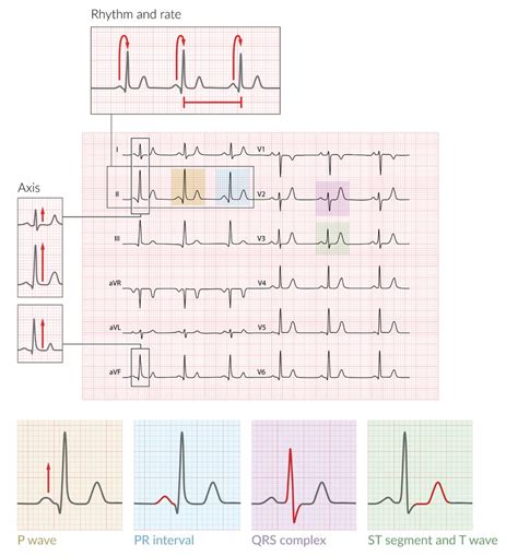 Normal Qrs Time