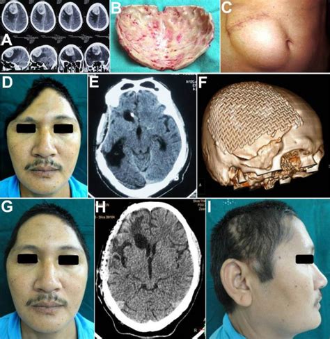 Reconstruction of Large Calvarial Defects Using Titanium Mesh Versus ...