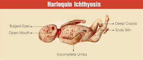 Harlequin Ichthyosis - On Both Fronts