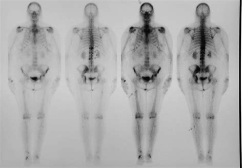 Metastatic Bone Disease Fact Sheet | Westmead BCI