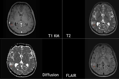 Pilocytic astrocytoma MRI : r/Radiology