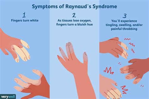 Raynaud's Syndrome: Symptoms, Diagnosis, and Treatment