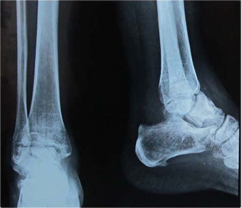 Ankle Arthrodesis - Foot & Ankle - Orthobullets