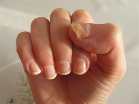 Explainer: why do we get fungal nail infections and how can we treat them?