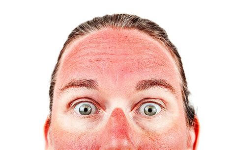 Dermatitis solaris - was tun bei einem Sonnenbrand? » gesund.co.at