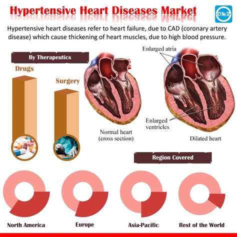 Hypertensive Heart Disease Market Share, Trends, Growth Research Report ...