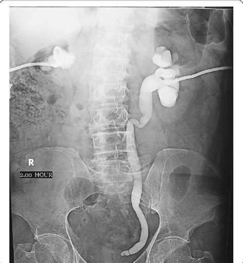 Bilateral nephrostogram showing Rt pelvic junction obstruction and left ...