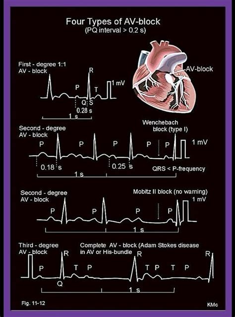 ECG Heart Block Rhythms - Four types of atrio-ventricular (AV)-block ...