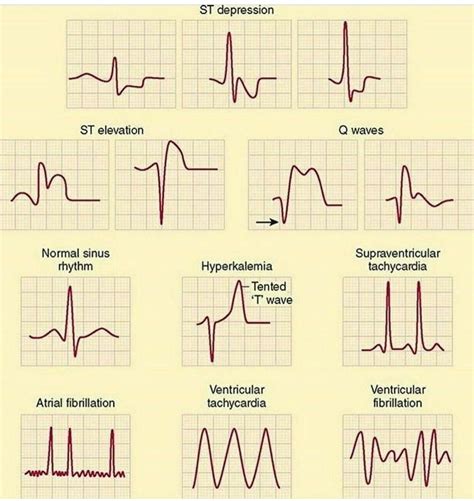 Abnormal Ecg Normal Sinus Rhythm Hotsell | vivatumusica.com